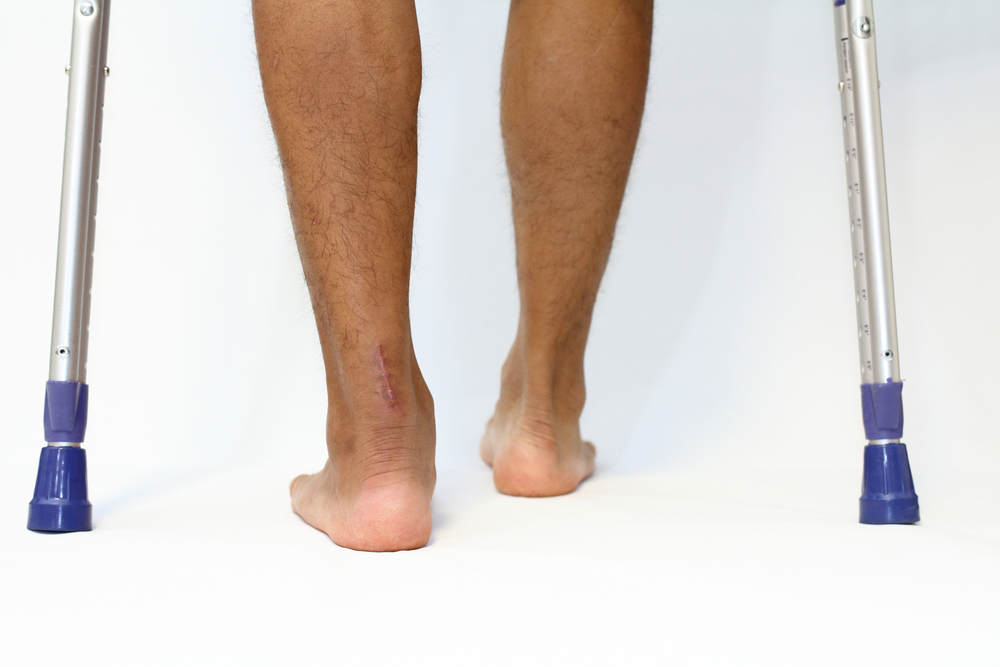 Achilles tendon rupture: Throw the kitchen sink at it