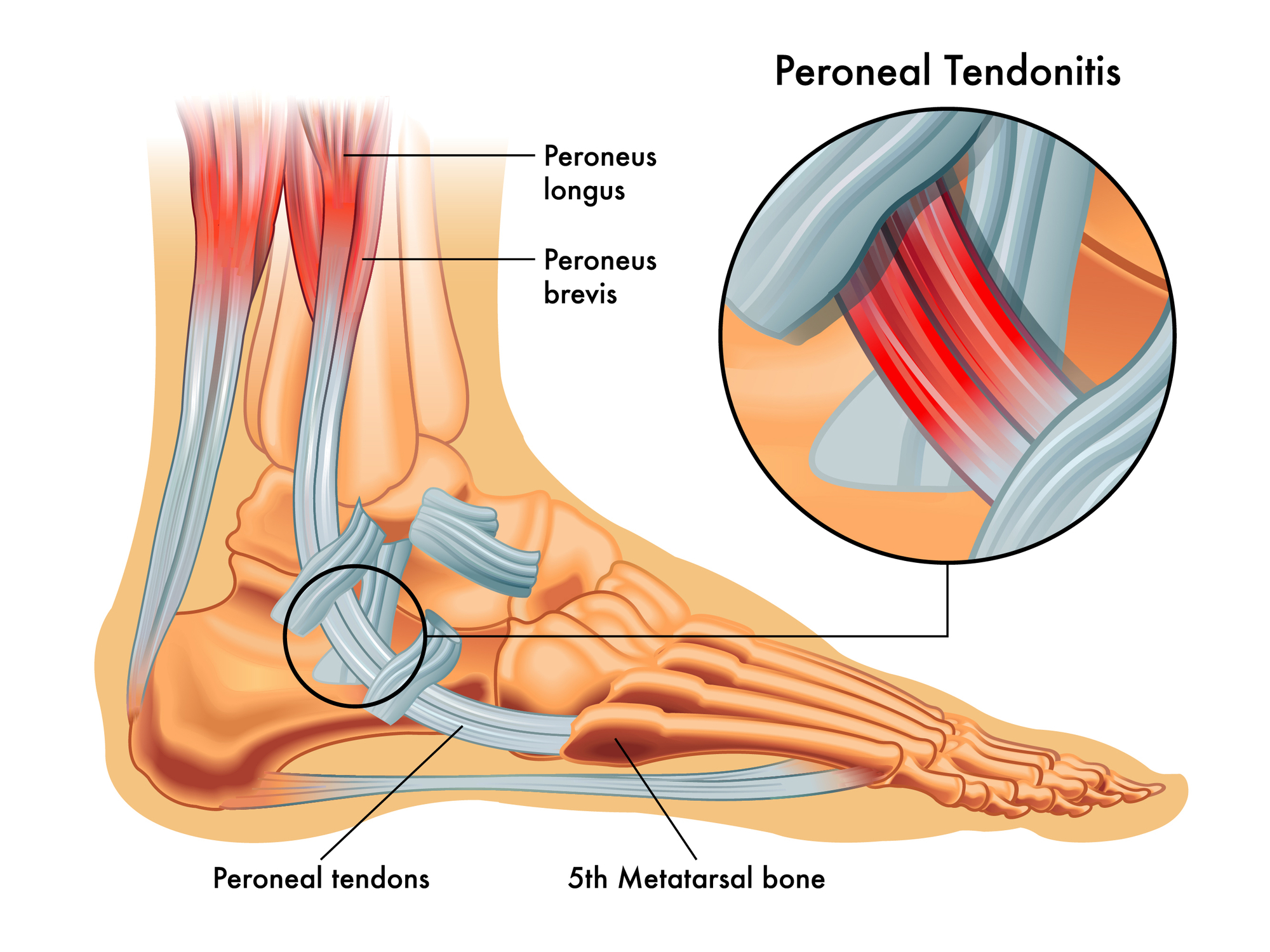 Peroneal tendonitis: throw the kitchen sink at it
